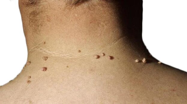Papilomi na vratu - posljedica poraza virusa