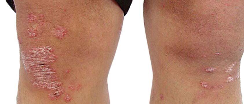 Psorijaza je neugodna bolest kože koja zahtijeva liječenje kremom Keraderm
