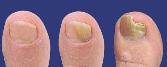 Razvoj gljivica noktiju na nogama