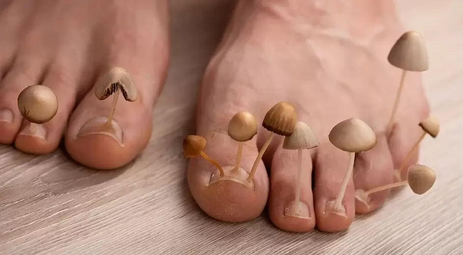 Gljivična infekcija koja zahvaća nokte na nogama