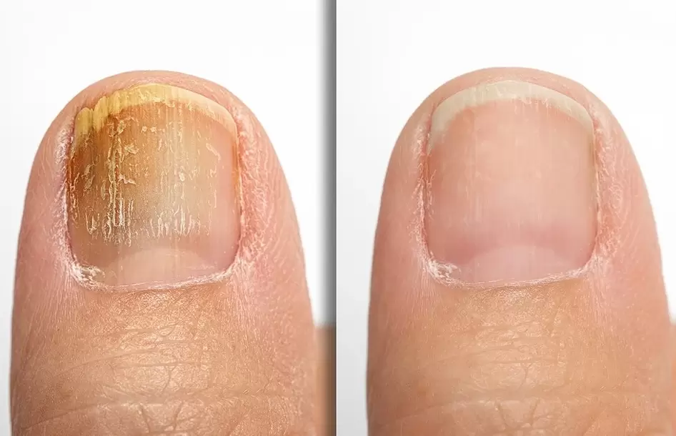 Nokat sa znakovima gljivica (lijevo) i zdrav nokat (desno)