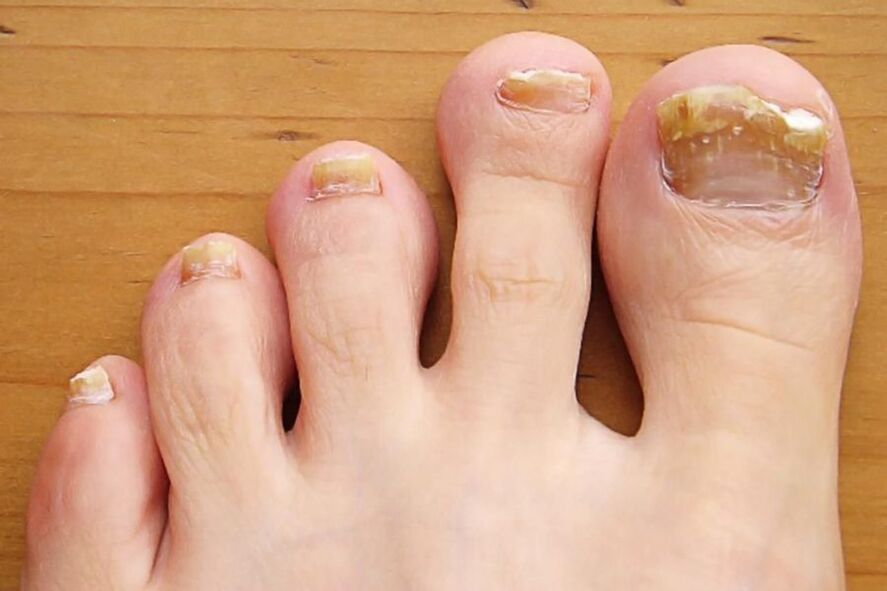 simptomi gljivica na noktima