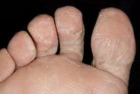 Koža stopala s gljivičnom infekcijom