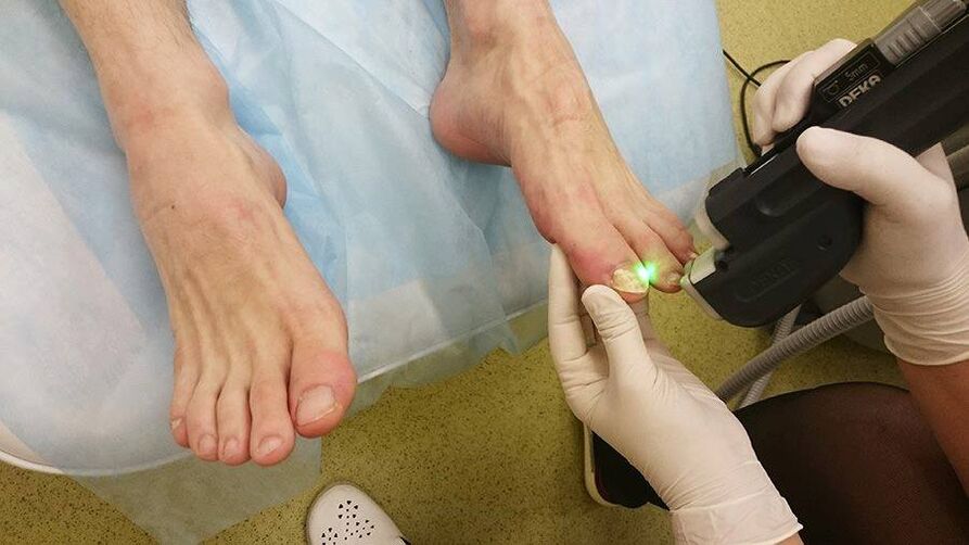 Lasersko liječenje gljivica na noktima nogu