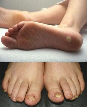 Manifestacije mikoze na koži i noktima stopala