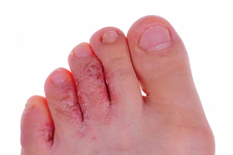 Simptomi rubrofitoze - pukotine i ljuske na koži nogu