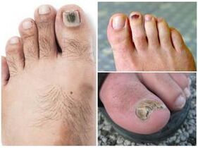 Znakovi gljivične infekcije noktiju na nogama