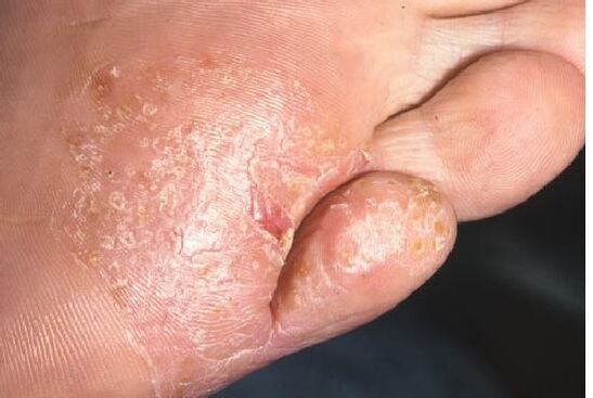 Manifestacije gljivične infekcije na koži stopala
