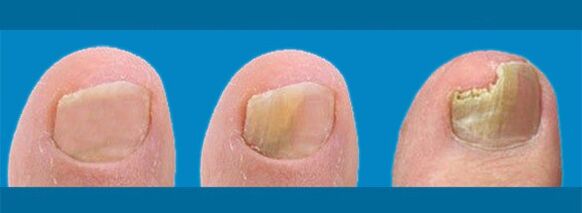 Razvoj onihomikoze - gljivica noktiju na nogama